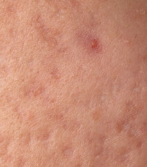 Acne scars on the skin. Macro.