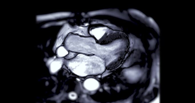 MRI of heart or Cardiac MRI ( magnetic resonance imaging ) of heart showing heart beating for detecting heart disease.