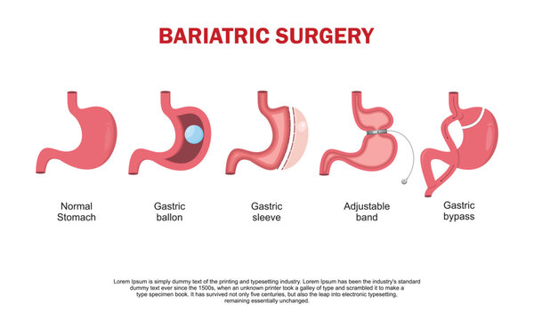 Stomach With Adjustable Gastric Band Device. Bariatric Surgery Weight Loss Procedure. Stomach Reduction Anatomical Diagram Infographic. Health Care Medical Concept. Vector Illustration