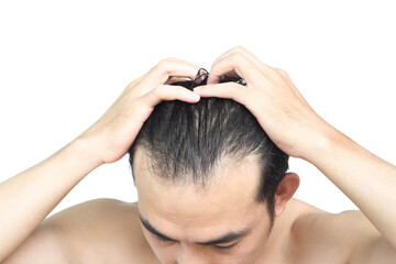 Closeup Young man serious hair loss problem with white backgroun for health care medical and...