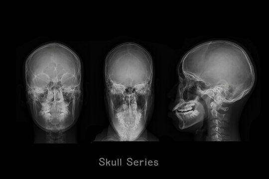  x-ray image of Skull  AP,Town's and Lateral view  or Skull series for diagnosis skull fracture  isolated on Black Background.