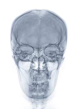 X-ray image of Human Skull   Front  view for diagnosis skull fracture  isolated on Black Background.