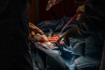 Hip Surgery in Progress: Detailed Footage of Surgeons in the Operating Room