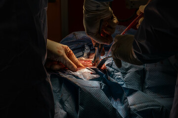 Hip Surgery in Progress: Detailed Footage of Surgeons in the Operating Room