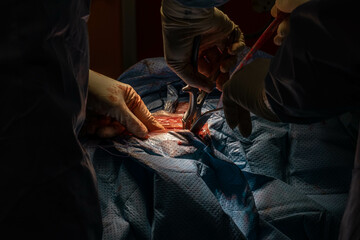 Hip Surgery in Progress: Detailed Footage of Surgeons in the Operating Room