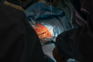 Hip Surgery - Closing the Wound with Surgical Stitches