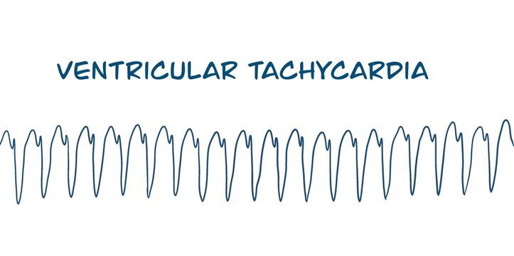 ECG example of monomorphic VT