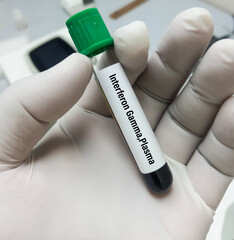 Scientist holds blood sample for Interferon gamma test to diagnosis of tuberculosis. IGRA test.