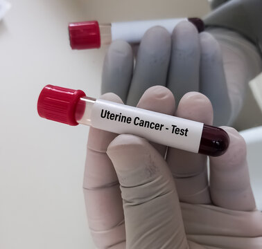 Blood sample for Uterine cancer test, CA 125.