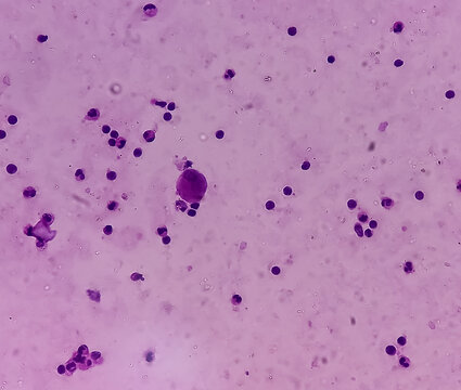 Ascetic fluid cytology, microscopically show lymphocytes, neutrophils accasional histiocytes, background show proteinaceous material. No malignant cell seen.
