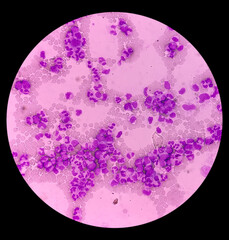 Blood cancer. Chronic myeloid leukemia(CML) with Thrombocytopenia. Chronic myelogenous leukemia....
