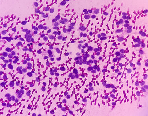 USG guided FNA cytology from liver SOL. Non-Hodgkin lymphoma. Smear show atypical small round cells and inflammatory cells and blood background. Metastatic carcinoma.