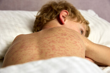 Sad boy lies on the bed in the room, his whole body covered with red allergic spots. A small child has a hard time tolerating chickenpox, the whole body is in a red rash - obrazy, fototapety, plakaty