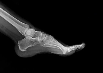 X-ray of the foot bones of a 22-year-old woman, heel spur