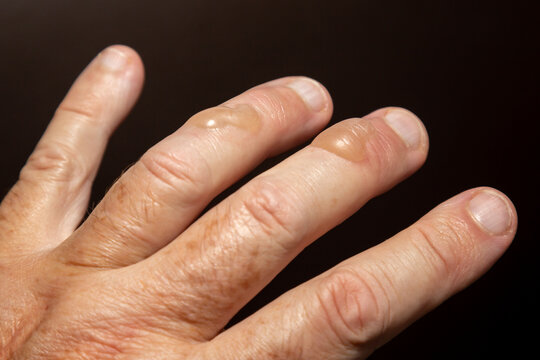 Typical blisters on the skin from second-degree burning by boiling oil. second degree burn