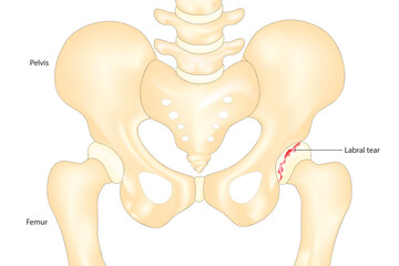 Hip labral tear