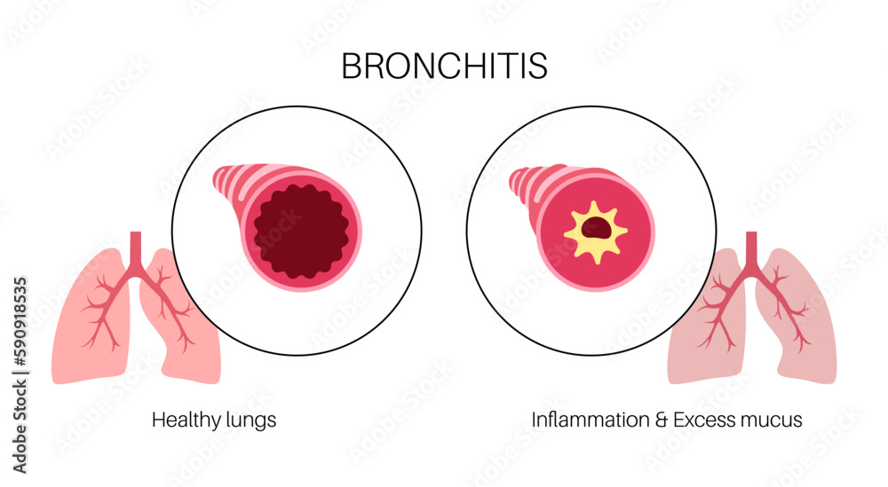 Canvas Prints Bronchitis lung disease