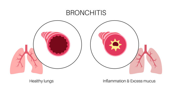 Bronchitis lung disease