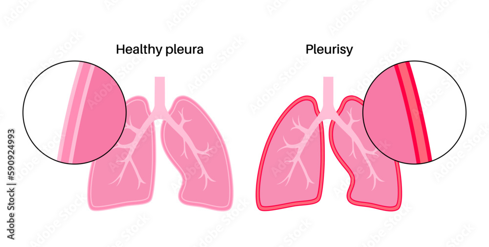 Poster Pleurisy inflammation diseases