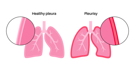 Pleurisy inflammation diseases