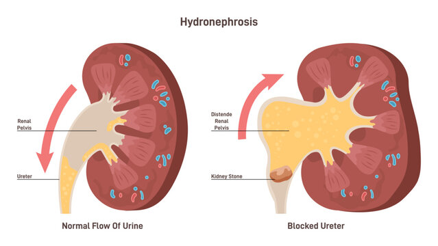 Hydronephrosis. Medical condition in which a kidney enlarge and swell