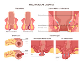 Proctological diseases set. Large intestine and rectum disorders - obrazy, fototapety, plakaty