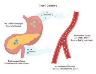 Type 1 diabetes. Juvenile diabetes or insulin-dependent diabetes.