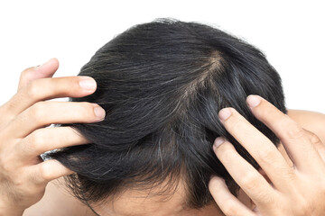 Closeup Young man serious hair loss problem with white backgroun for health care medical and shampoo product concept, selective focus