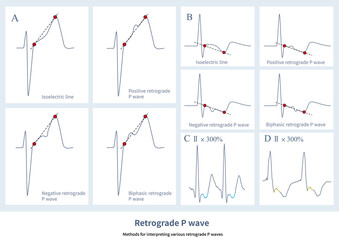 On the ECG, the retrograde P-wave can be a positive wave, a negative wave, a biphasic wave, or an equipotential line wave, which is related to the order of retrograde atrial depolarization.