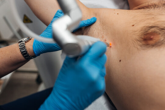 Laser removal of warts on the body in the clinic