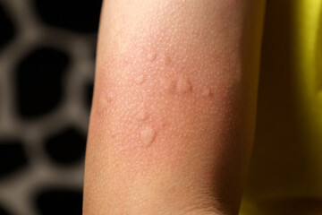 Skin texture, allergy shot, weeds, reaction. Allergy symptoms. Selective focus