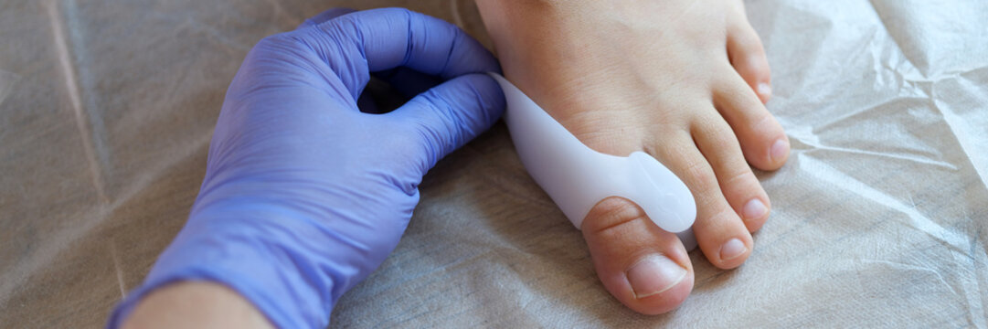 Doctor orthopedist applying brace for hallux valgus