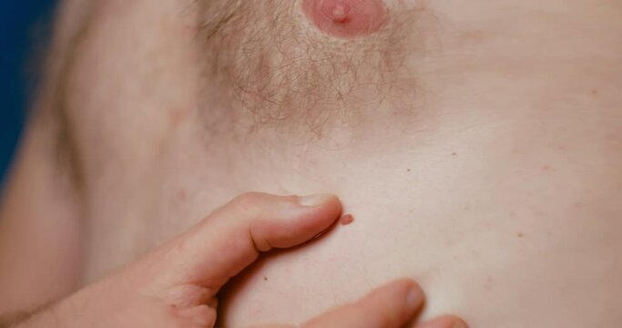 Mole birthmark nevus on man body. dermatology problem close-up