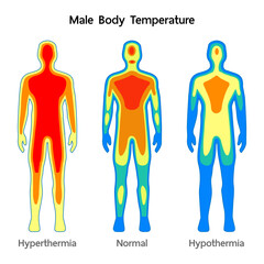 Male body Temperature model Normal, Hyperthermia and hypothermia health care infographic. Vector flat healthcare illustration. Body cooling infrared heat map isolated on white background.