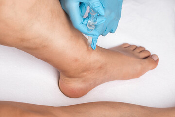 Removal of varicose veins on the legs. Medical inspection and treatment of Telangiectasia. Phlebeurysm.sclerotherapy
