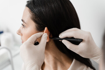Otoplasty markup for surgical reshaping of the pinna, or outer ear for correcting an irregularity...