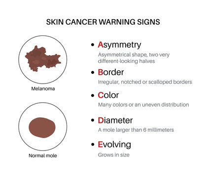 Melanoma warning signs