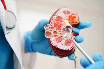 Chronic kidney disease, doctor holding model for treatment urinary system, urology, Estimated...