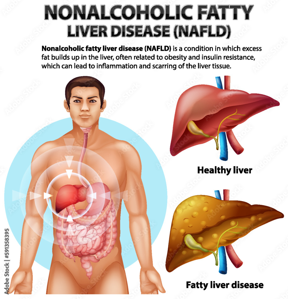 Canvas Prints nonalcoholic fatty liver disease