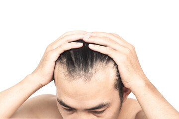 Closeup Young man serious hair loss problem with white backgroun for health care medical and shampoo product concept, selective focus