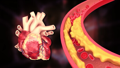 Cholesterol plaque in artery with human heart anatomy. 3d illustration..