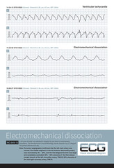 A patient with acute extensive anterior  myocardial infarction developed ventricular tachycardia during hospitalization and quickly experienced cardiac arrest.
