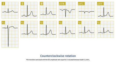 In chest leads, if the amplitude ratio of R wave to S wave is greater than 1 in leads V1 to V3, it is called counterclockwise rotation.