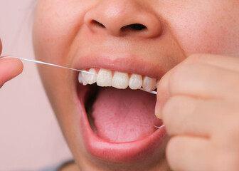 Close-up of smiling asian woman and cleaning for perfect smile. Healthy white teeth by flossing,...