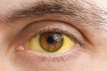 Man with yellow eyes, closeup. Hepatitis symptom