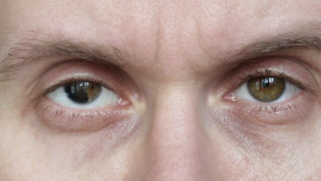 a person with iris dystrophy. eye diseases