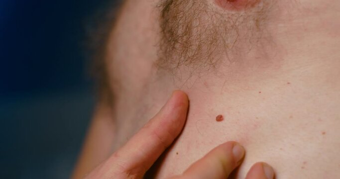 Close up of man investigate mole on body, problem skin