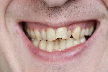 A person with malocclusion. crooked teeth