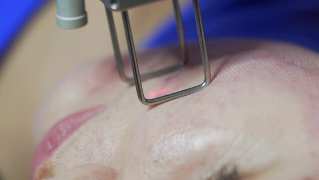 Vertical shot Beautician cosmetologist doing procedure fractional microneedle mesotherapy rejuvenation with laser technology. Hardware cosmetology in clinic salon for client.