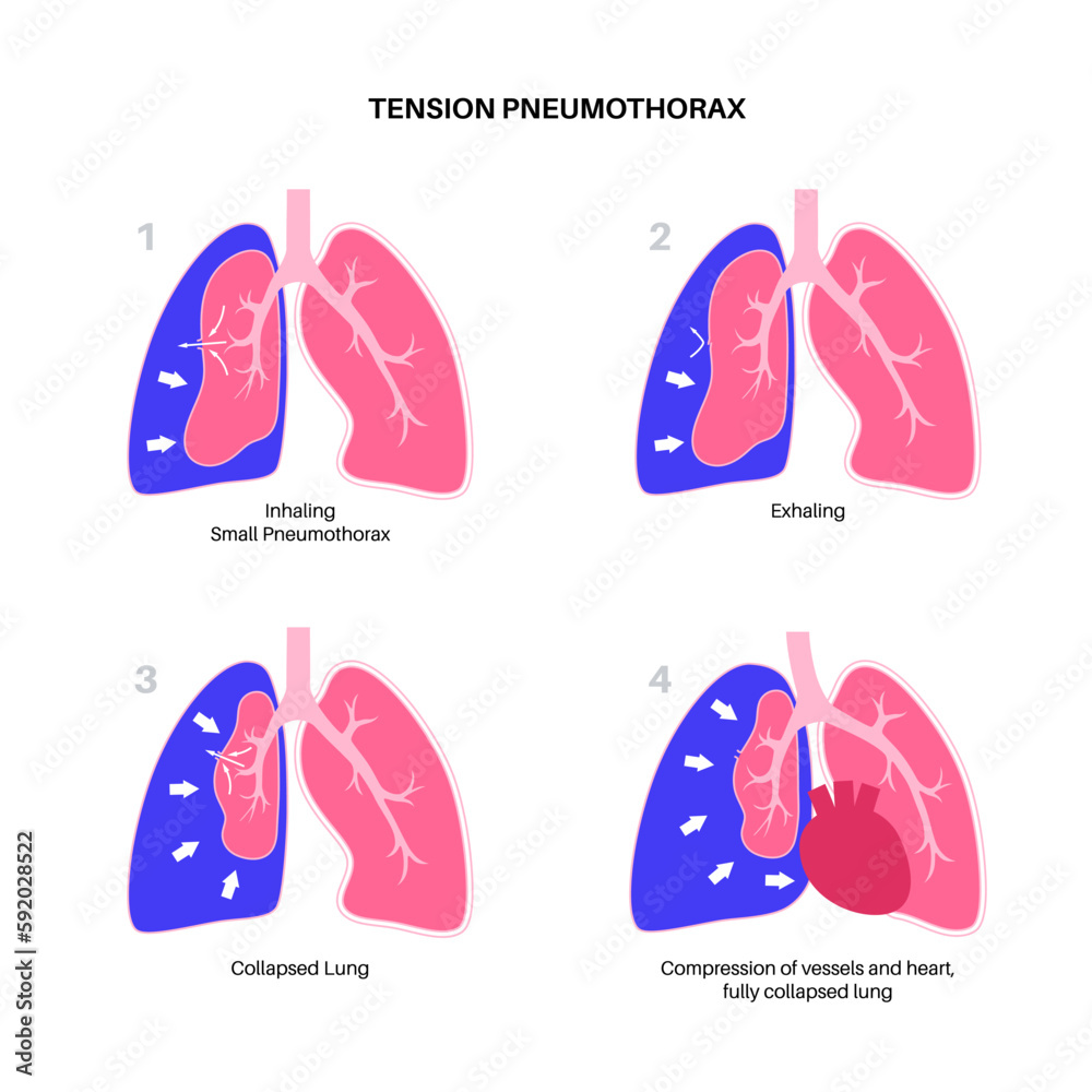 Sticker tension pneumothorax poster